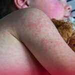 La epidemia de sarampión en México: Un legado de responsabilidad política que desafía la confianza pública