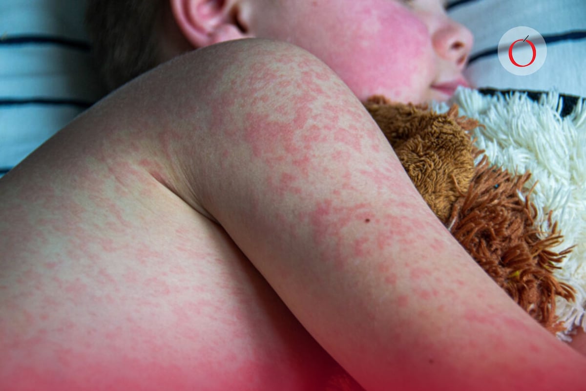 La epidemia de sarampión en México: Un legado de responsabilidad política que desafía la confianza pública